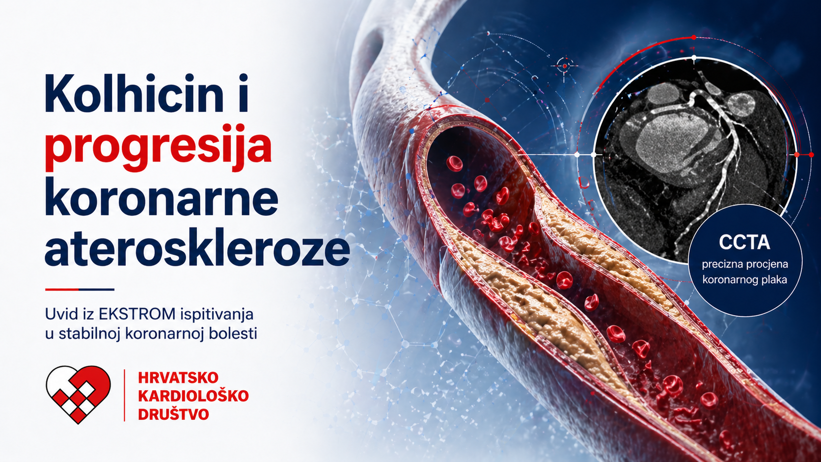 Kolhicin i progresija koronarne ateroskleroze